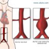 Come riconoscere la rottura dell’aorta addominale