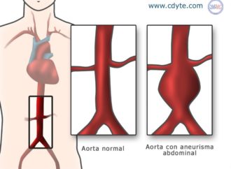 Come riconoscere la rottura dell’aorta addominale