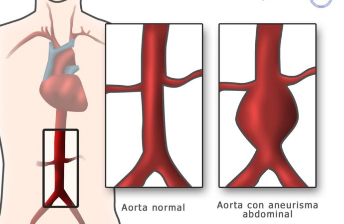 Come riconoscere la rottura dell’aorta addominale