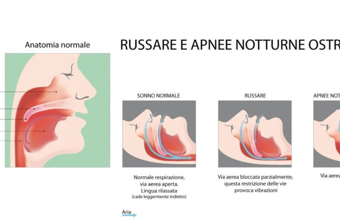 Apnea notturna: urge la formazione, malati non trattati