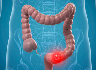 Colonproctologia: un problema sempre più attuale, se ne parla a Galatina