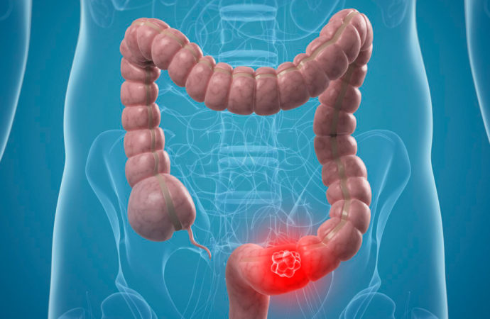 Colonproctologia: un problema sempre più attuale, se ne parla a Galatina