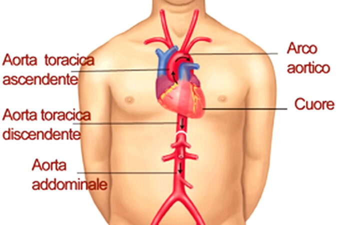 Intervento innovativo a Lecce dove si è ricostruita l’intera aorta